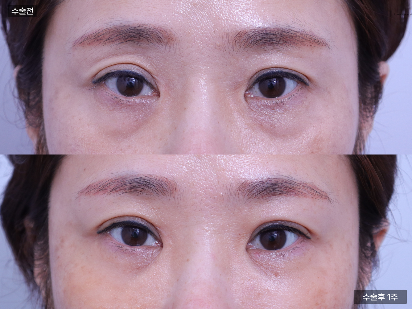 눈성형 [눈밑지방재배치]