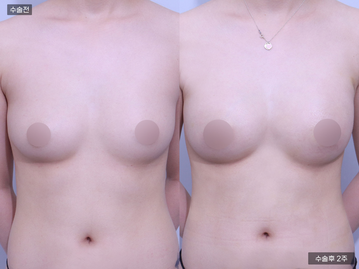 가슴성형 [가슴지방이식(250CC + 250CC)]