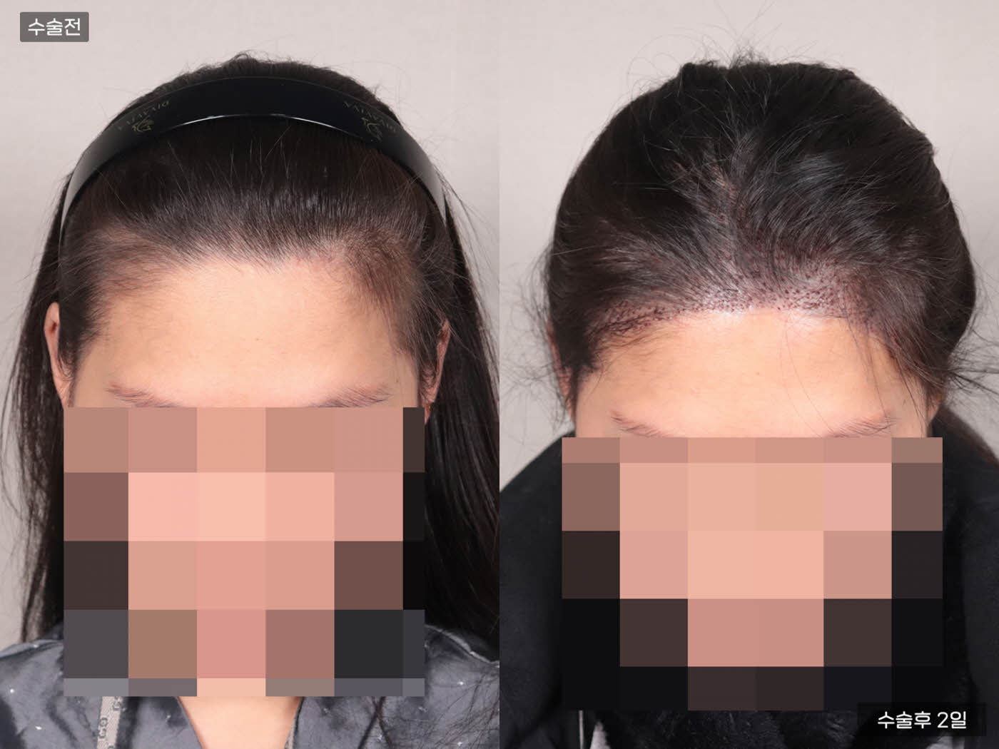 모발이식[비절개 모발이식(3000모)]