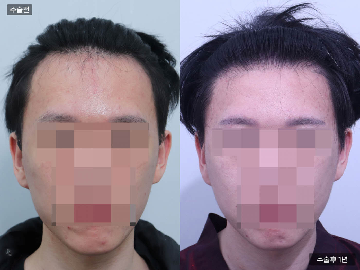 모발이식[절개 모발이식(3000모)]