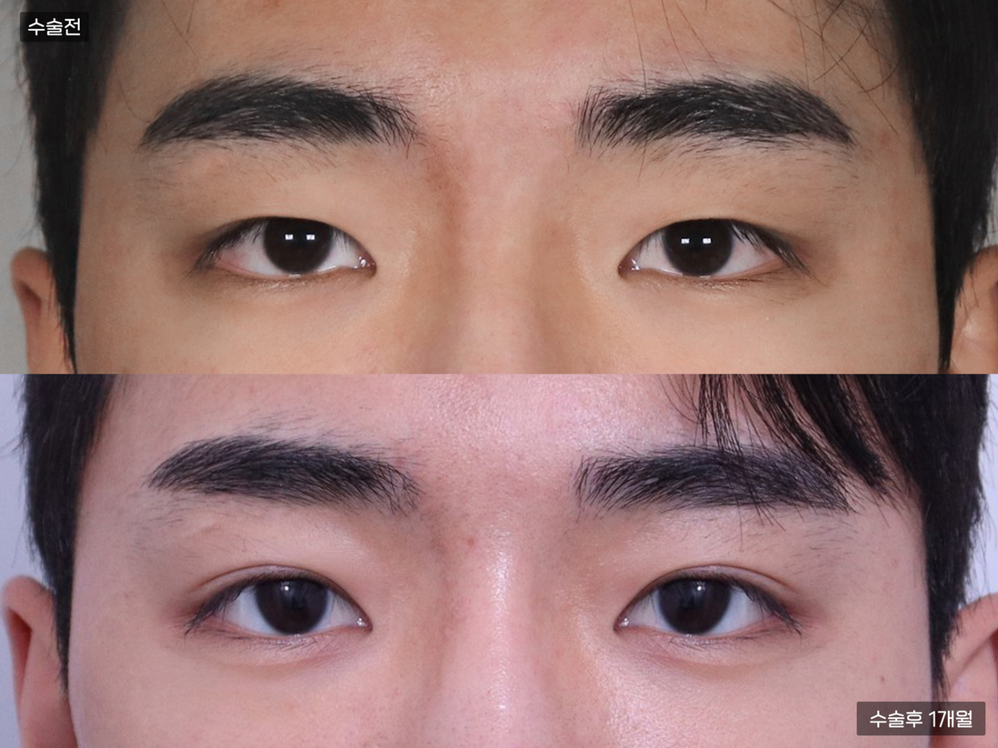 눈성형 [자연유착 쌍꺼풀 + 눈매교정]