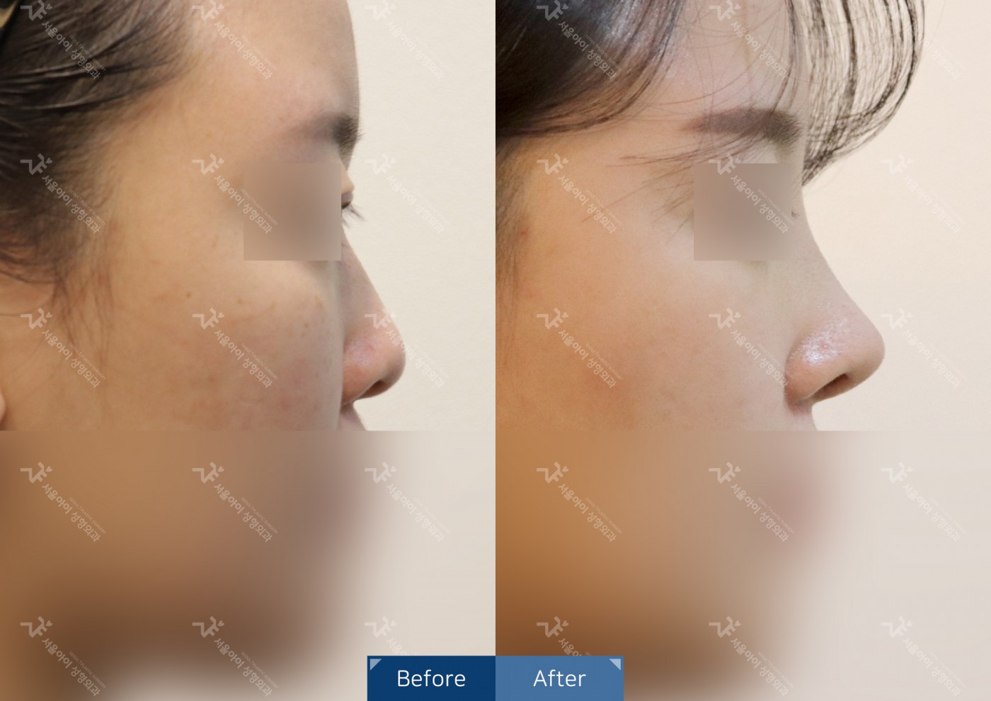 [코성형] 융비술&코끝조각술(비중격)+복코교정+매부리코교정