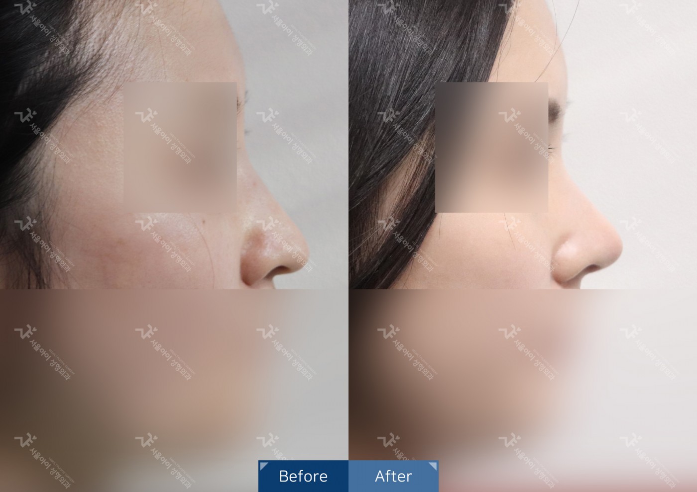 코성형 [융비술&코끝조각술(비중격)+복코교정+매부리코교정]