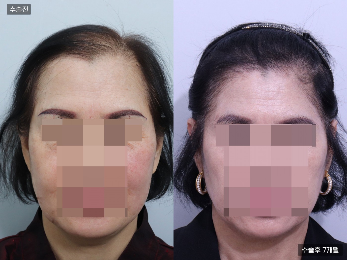 모발이식 [비절개 모발이식(3800모)]