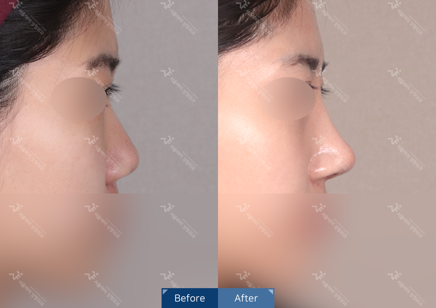 코성형 [기능코 3종+미용코]