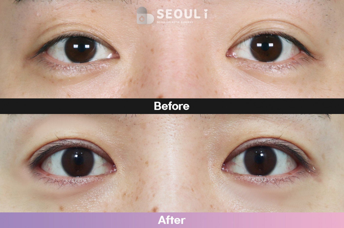 눈성형 [자연유착 쌍꺼풀 + 앞트임 + 눈매교정]