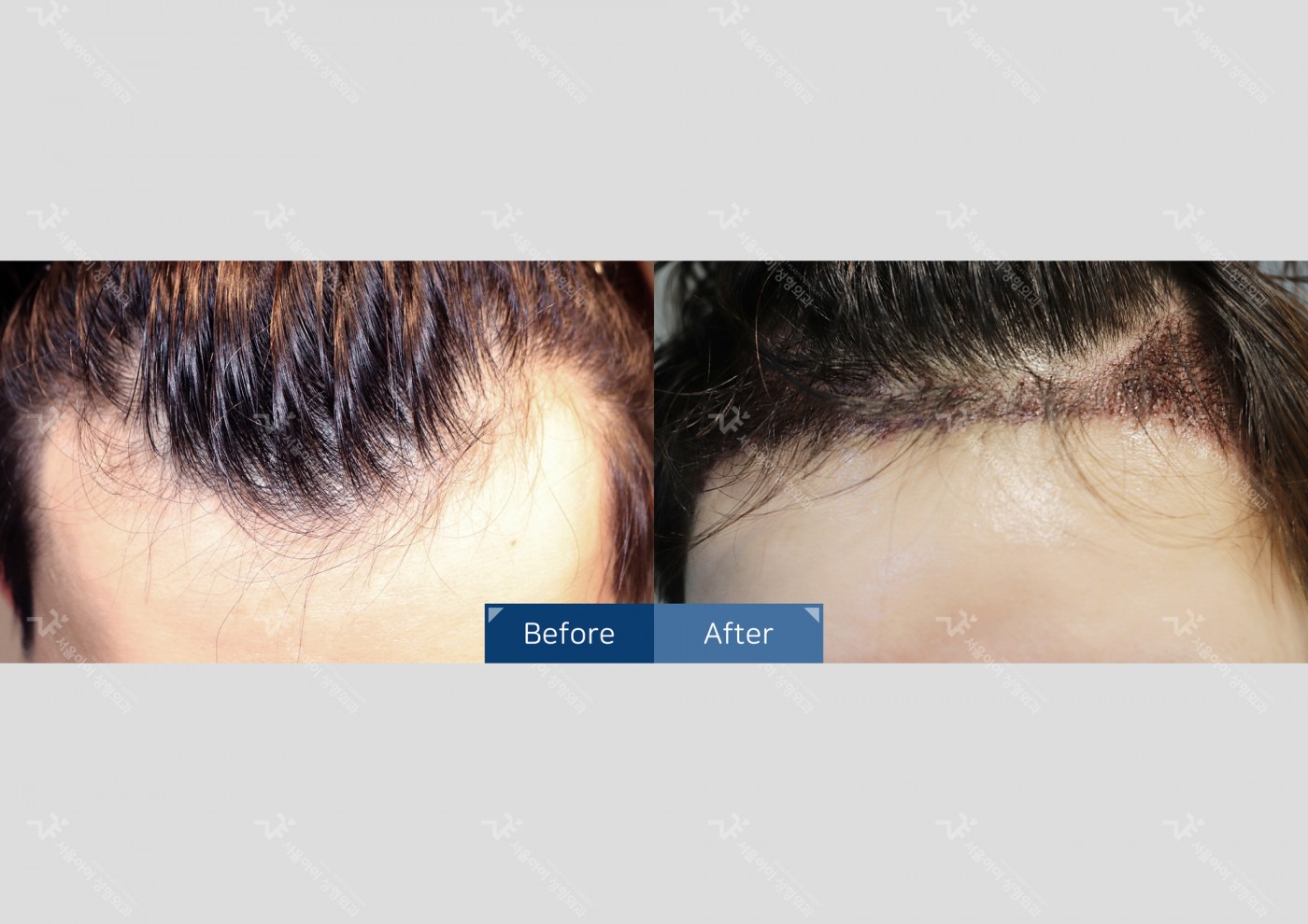 모발이식 [절개 모발이식(3000모)]