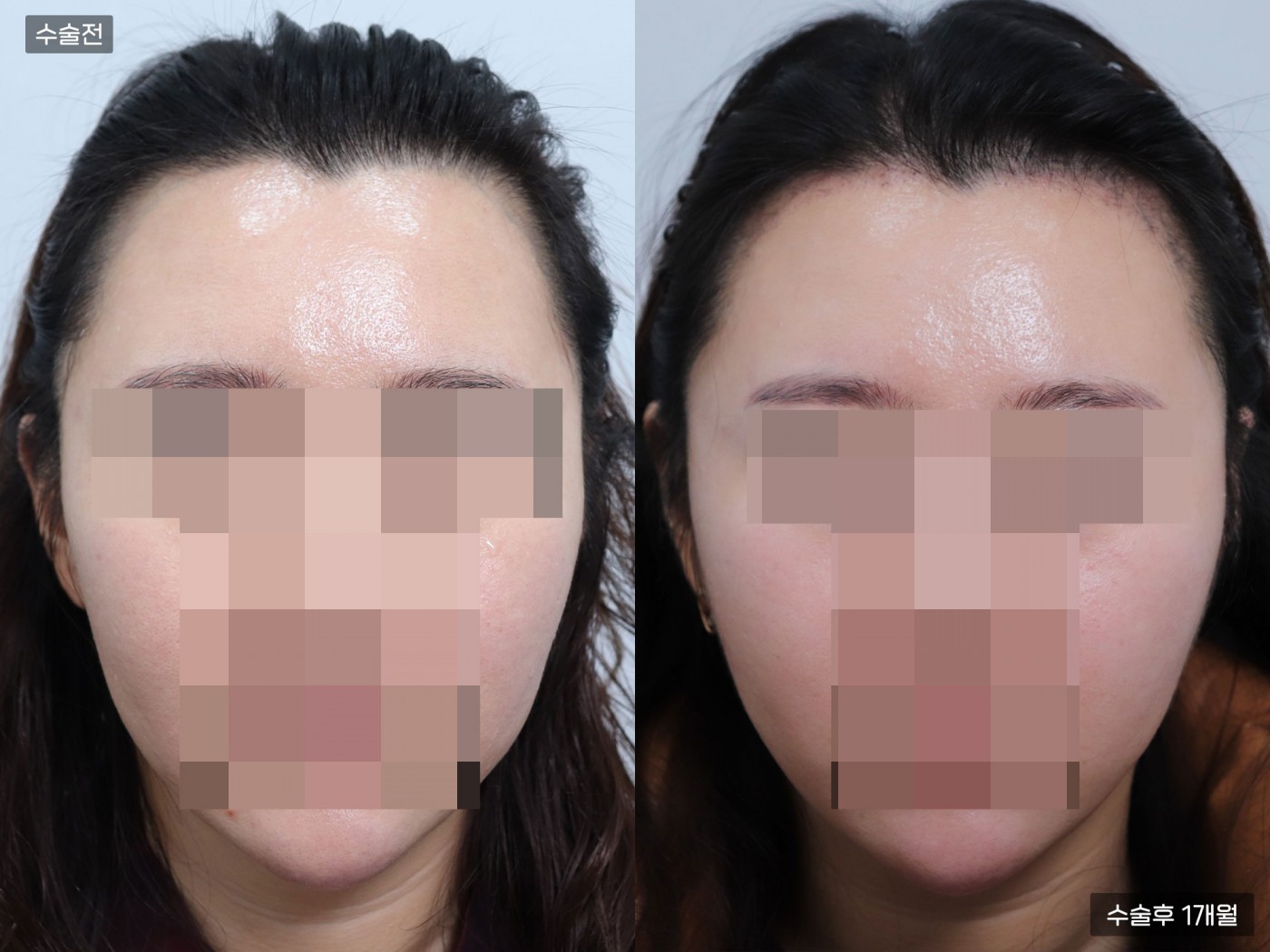 모발이식[비절개 모발이식(3000모)]