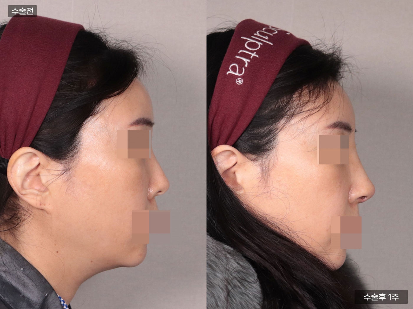 비공내리기 + 복코 + 매부리코