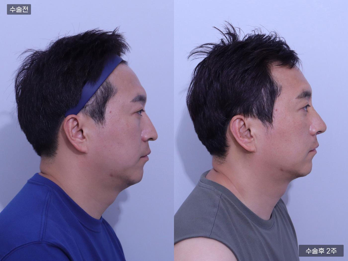 코끝(비중격) + 복코