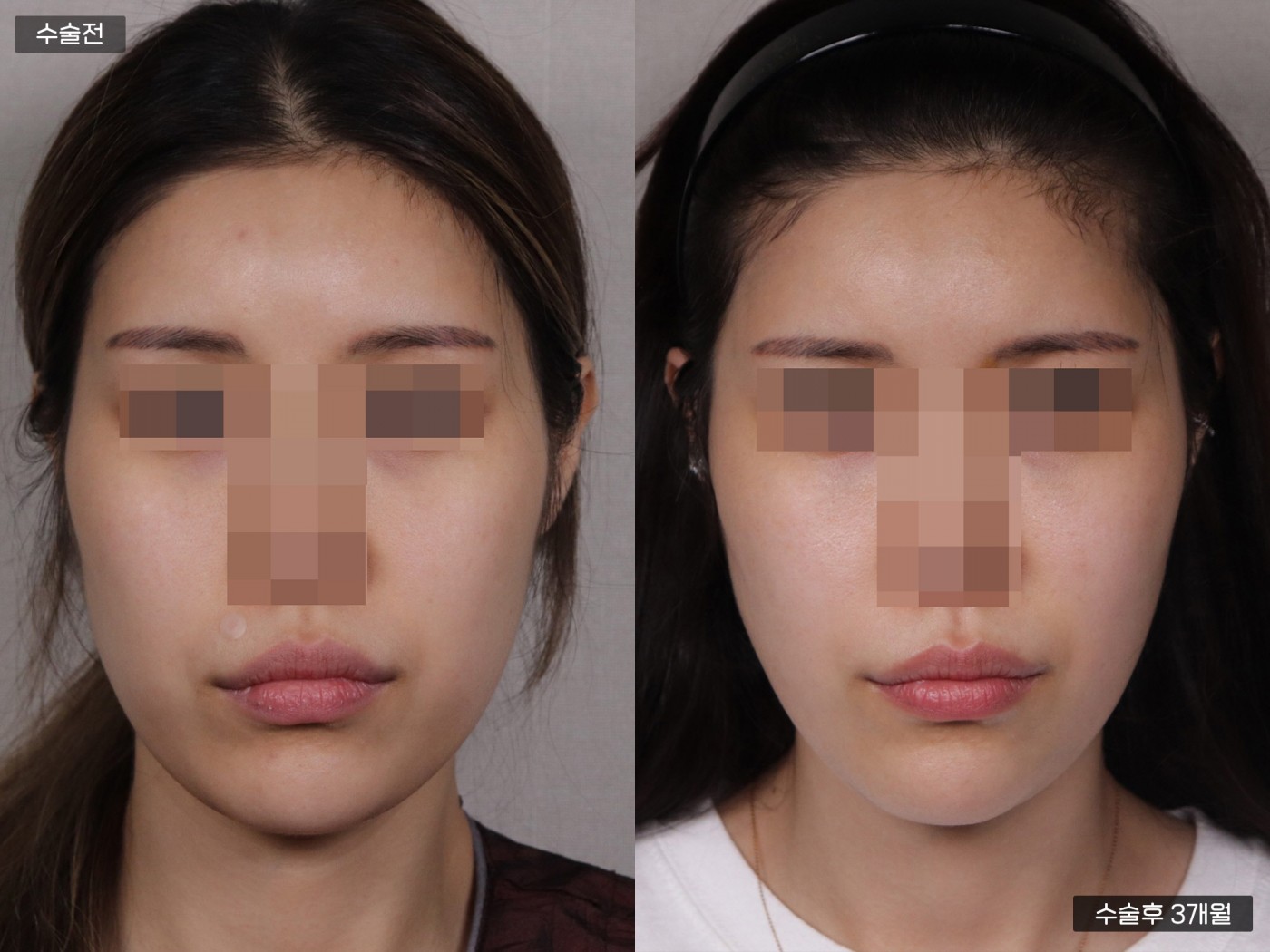 리프팅 [실리프팅]