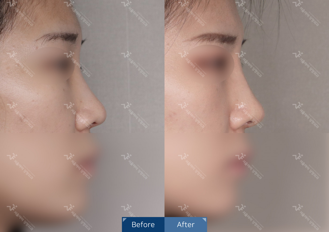 코성형 [융비술&코끝조각술(비중격)+복코교정술+메부리코]