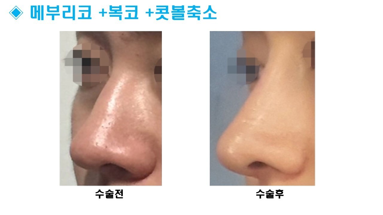 코성형 [메부리 + 복코 + 콧볼]
