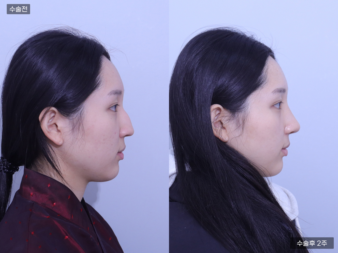 콧볼축소 + 매부리코 + 코끝(비중격)