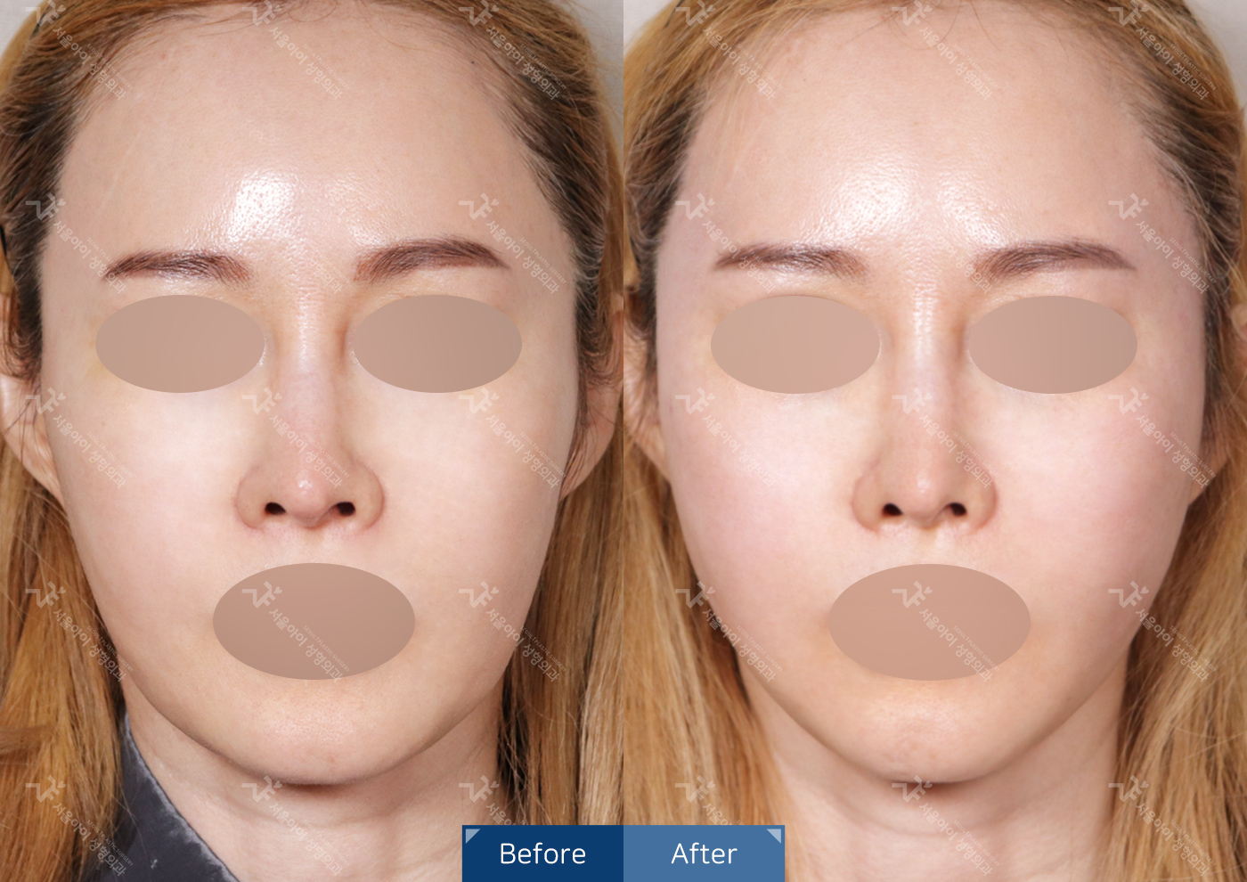 리프팅 [미니리프팅]