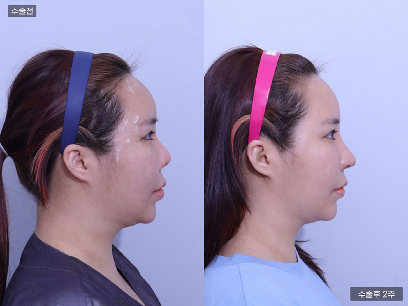 코재수술 + 코끝 + 콧볼축소 + 비공내리기