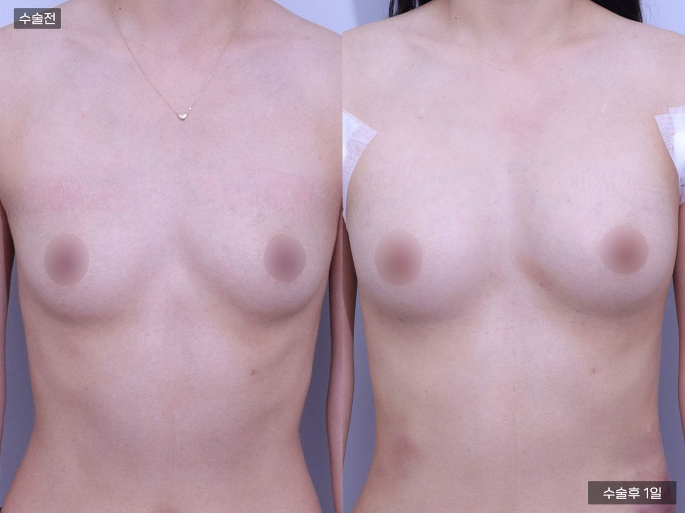 가슴성형 [가슴지방이식(300CC + 300CC)]