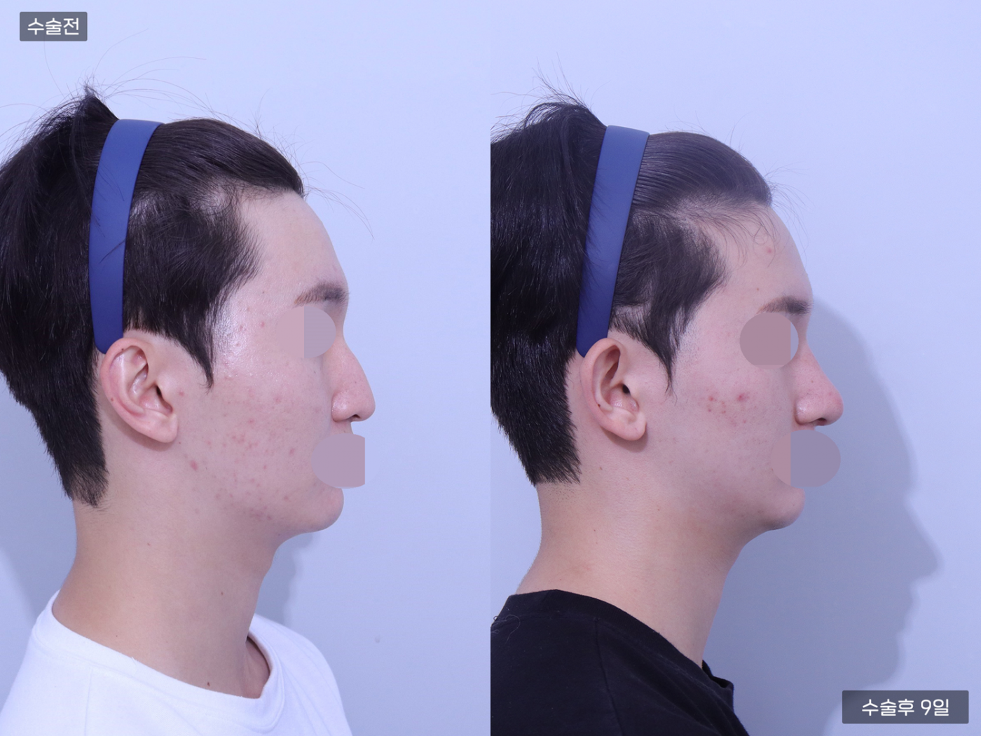 코끝 + 매부리코 + 콧볼축소