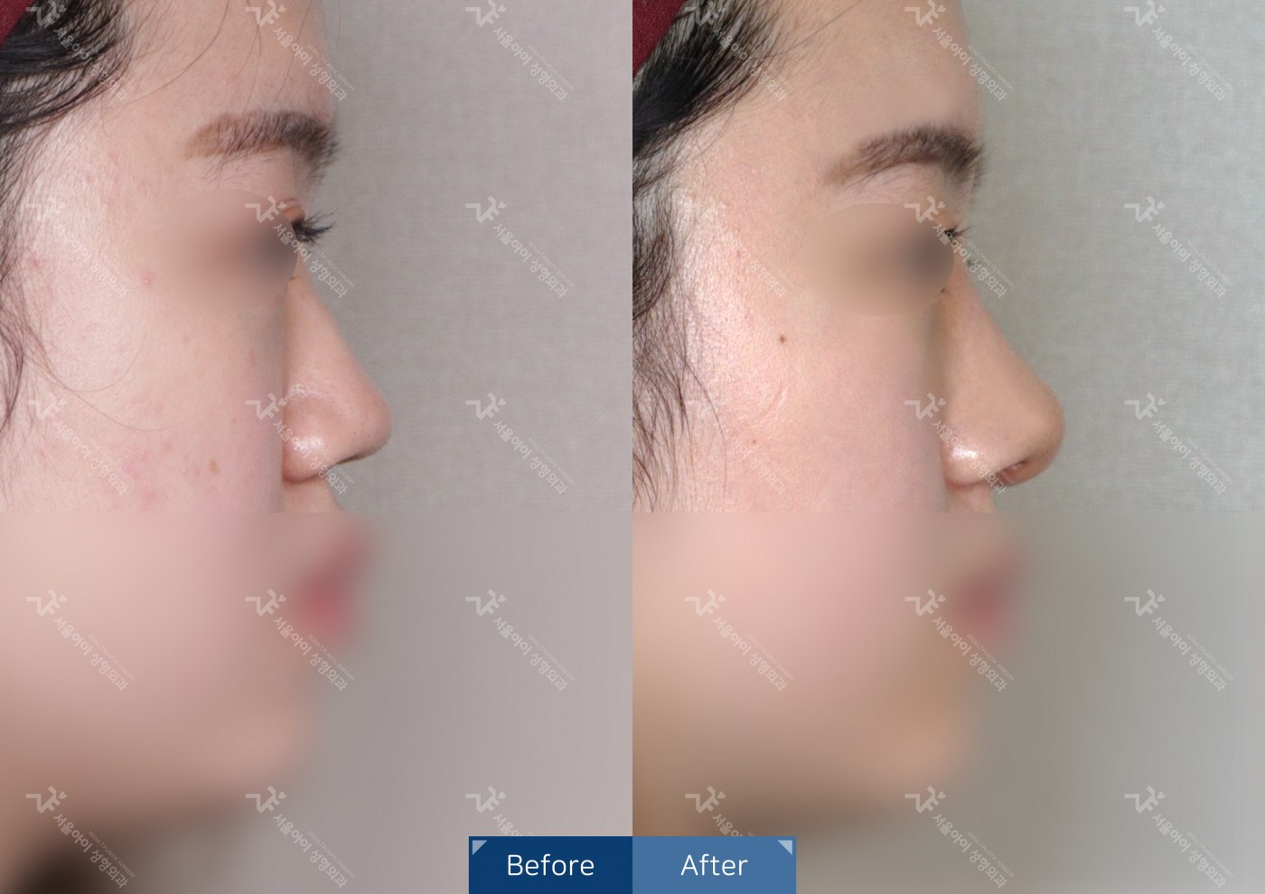 코성형 [코끝조각술+비중격+복코교정술+메부리코+콧볼축소술]