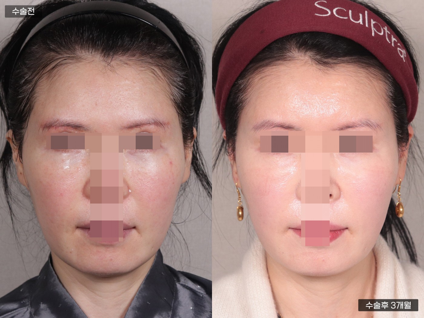 지방이식 [풀페이스]