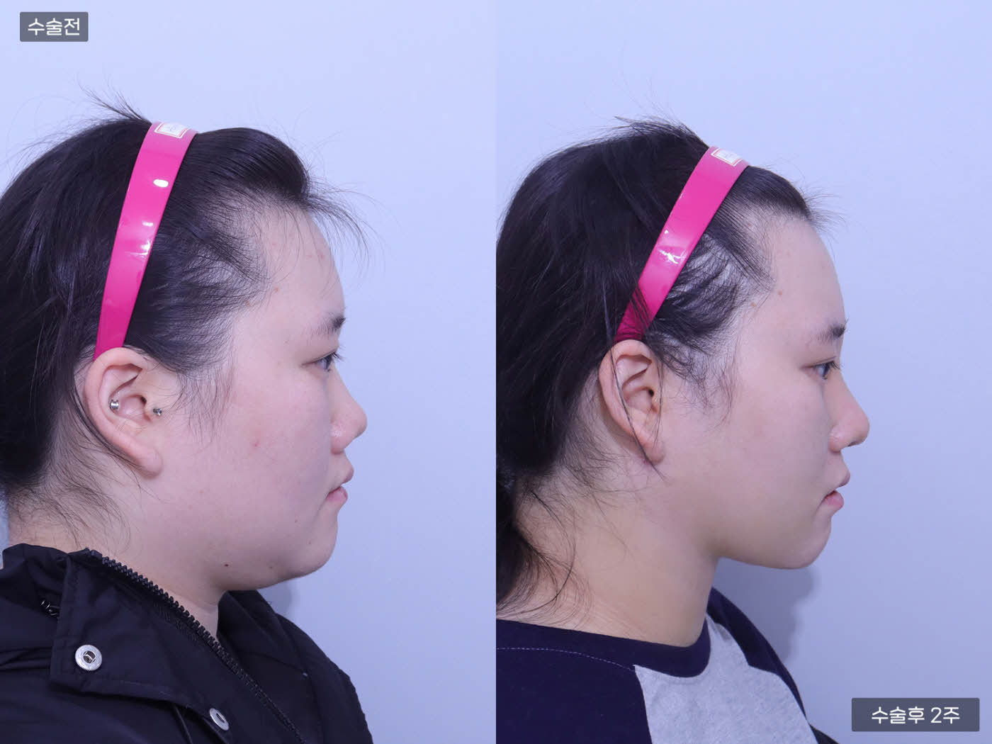 코끝 + 복코 + 매부리코 + 얼굴전체지흡