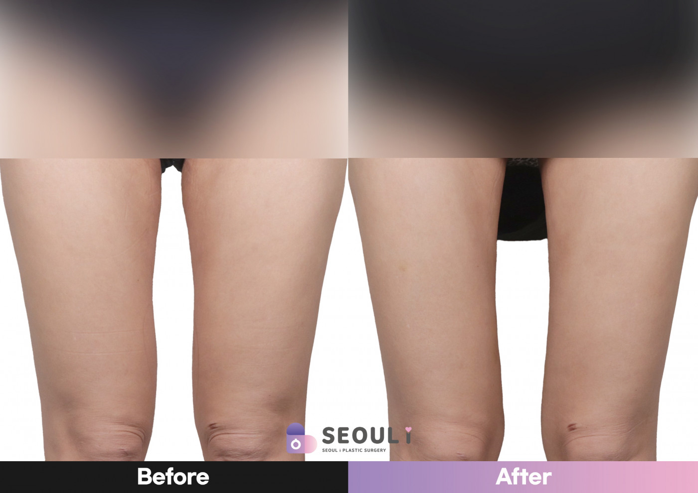 허벅지 지방흡입