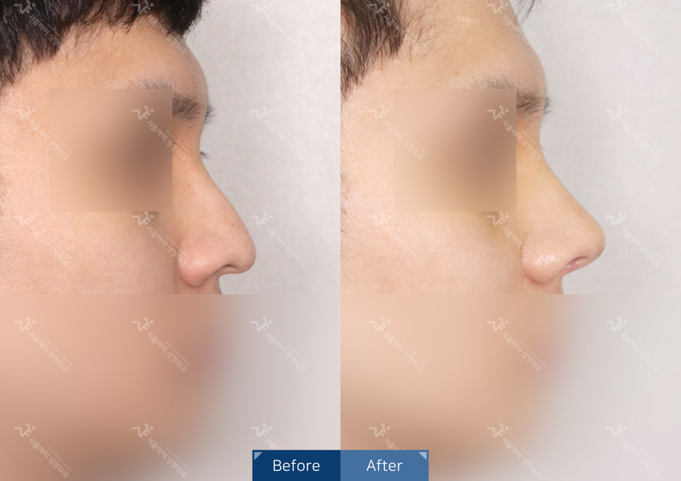 코성형 [코끝조각술+복코교정+매부리코교정]