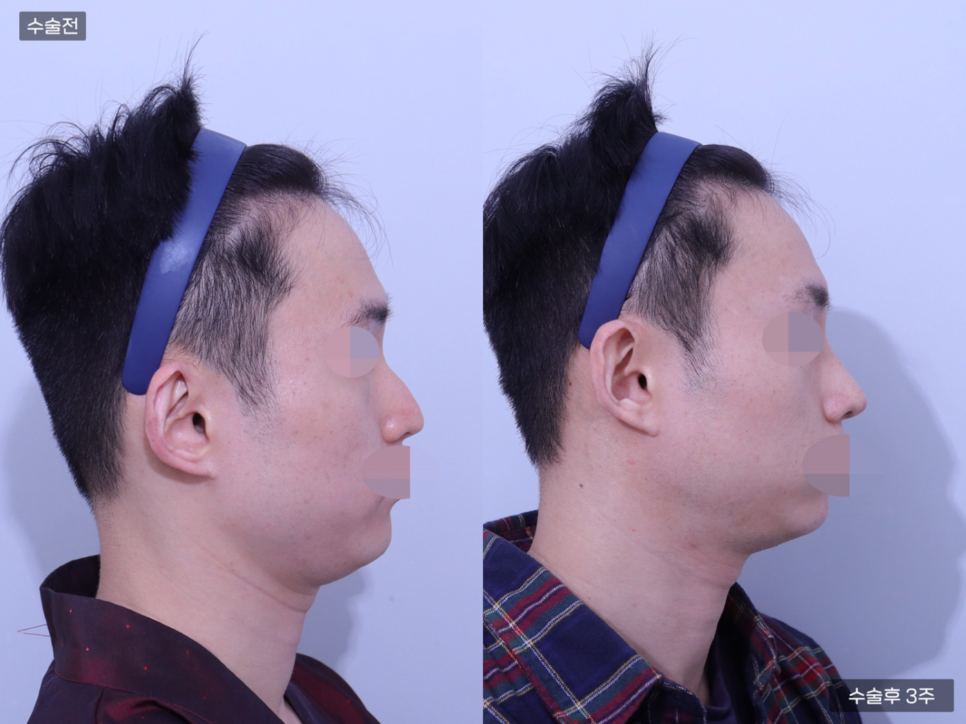 코끝(비중격) + 복코교정 + 매부리코