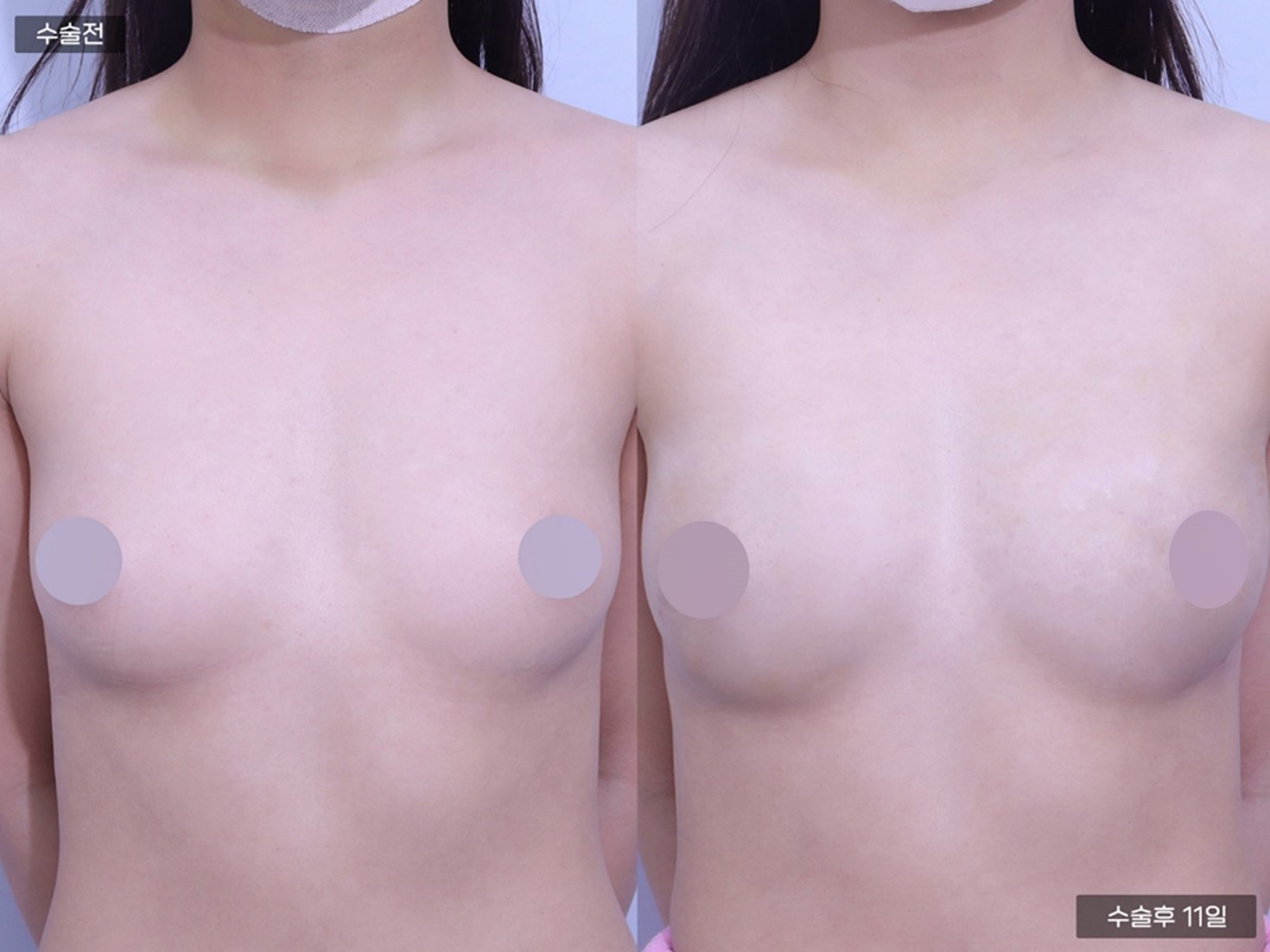  줄기세포 가슴지방이식 (225cc+225cc)
