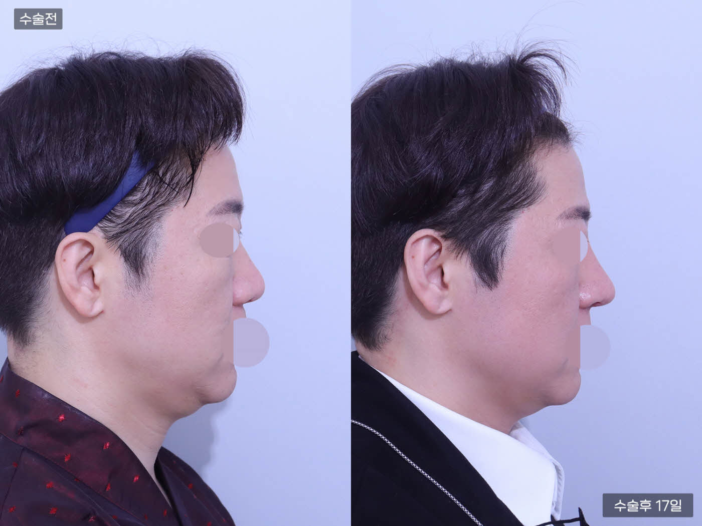 코끝 + 콧볼축소 + 매부리코 +복코