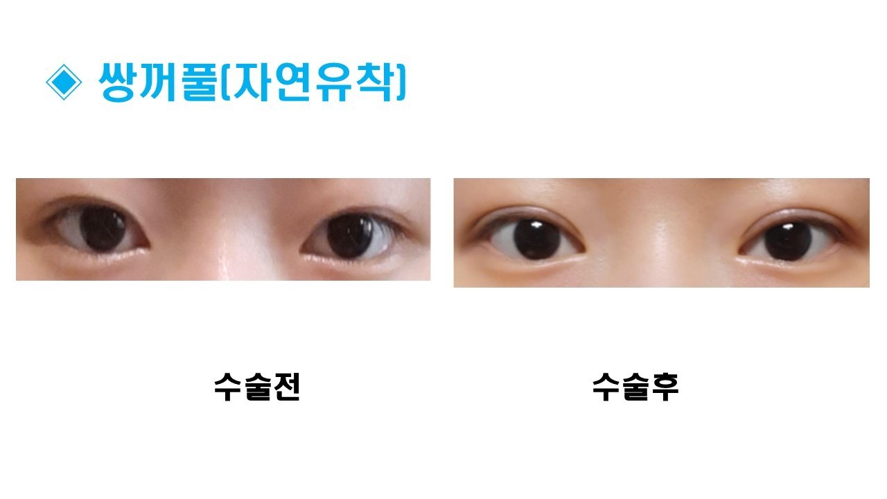 자연유착 쌍꺼풀