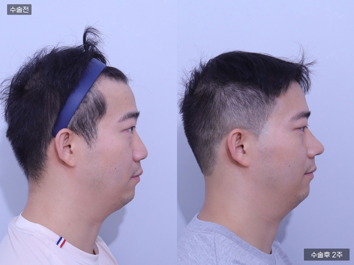 코끝(비중격) + 복코 + 매부리코 + 콧볼축소