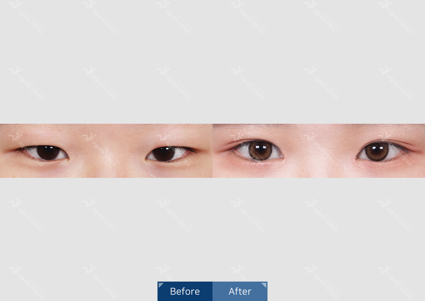 눈성형 [자연유착 쌍꺼풀 + 지방제거 + 뒷밑트임]