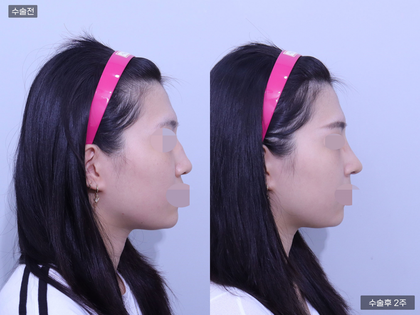 코끝 + 복코교정 + 매부리코