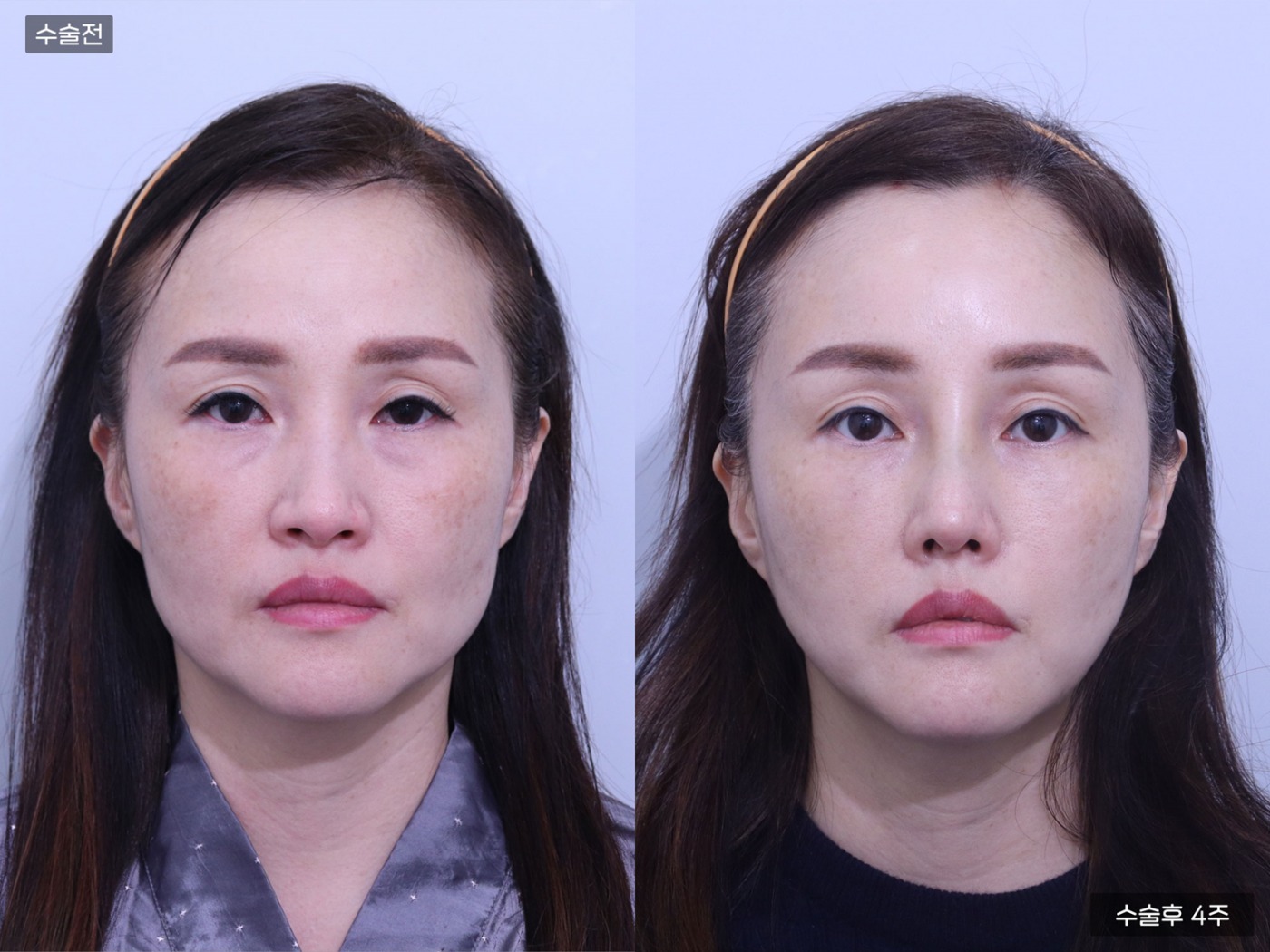 리프팅 [이마거상]