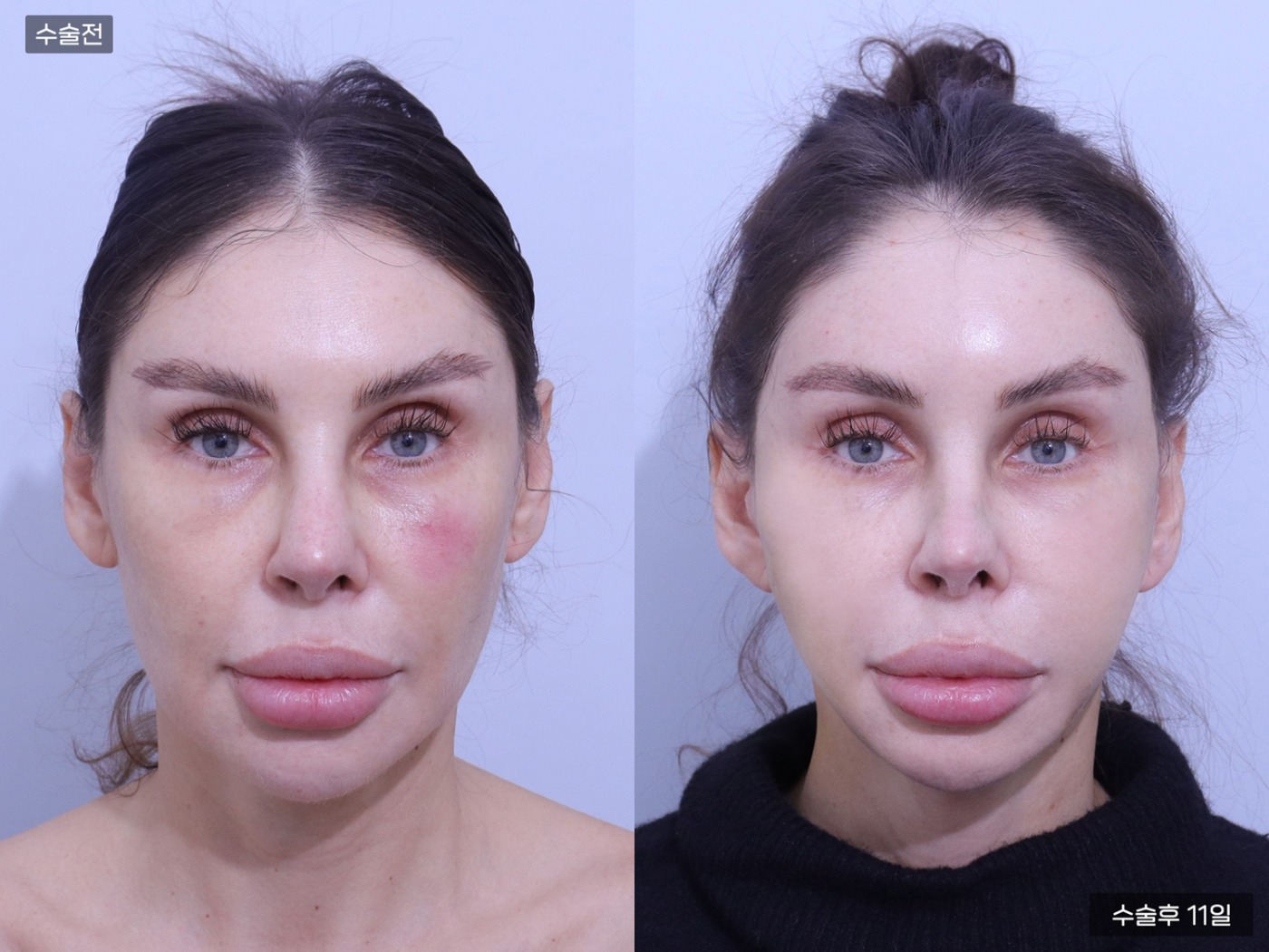 리프팅 [안면거상]