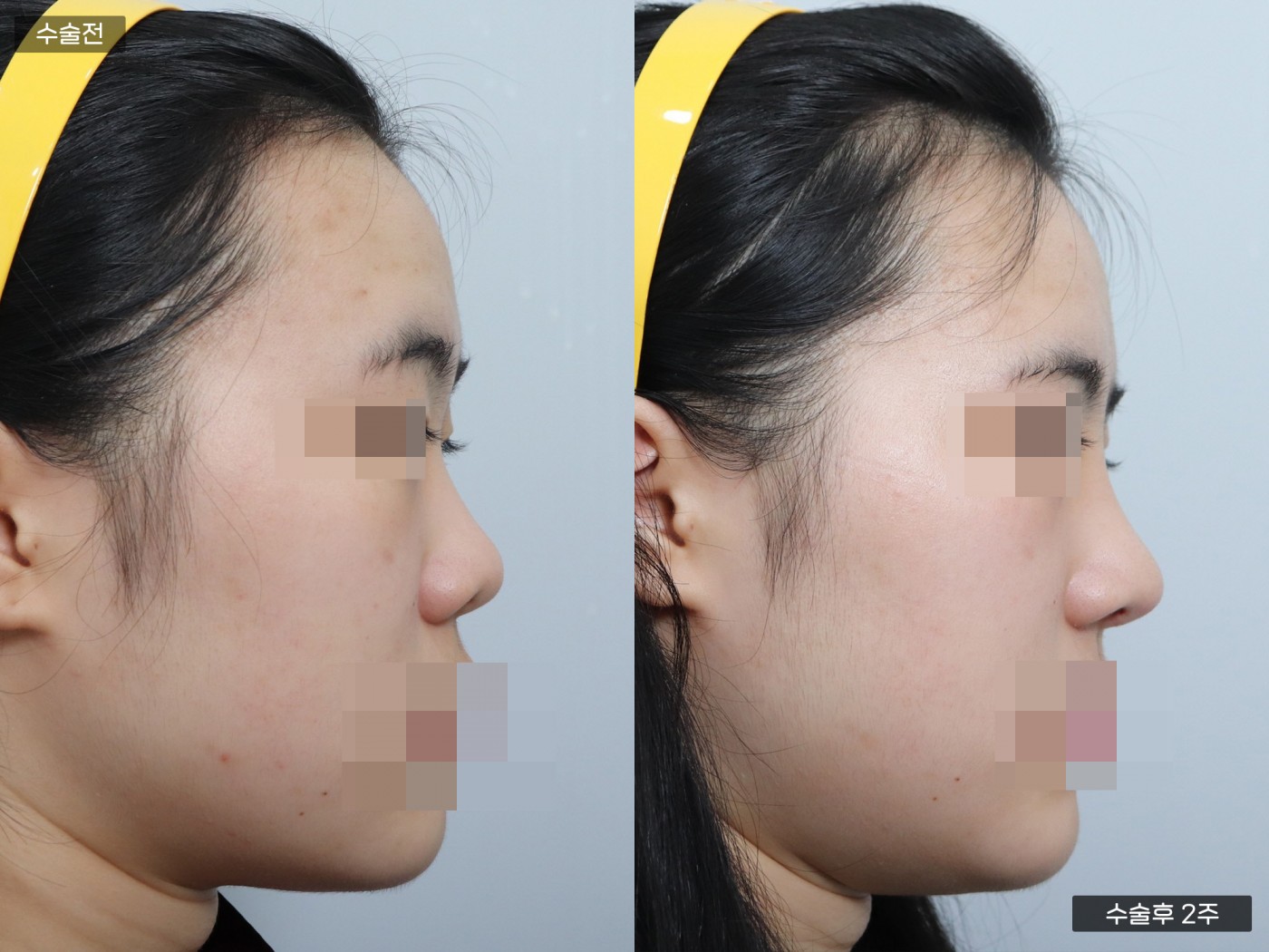 낮은코 + 복코 + 매부리코 + 콧볼축소