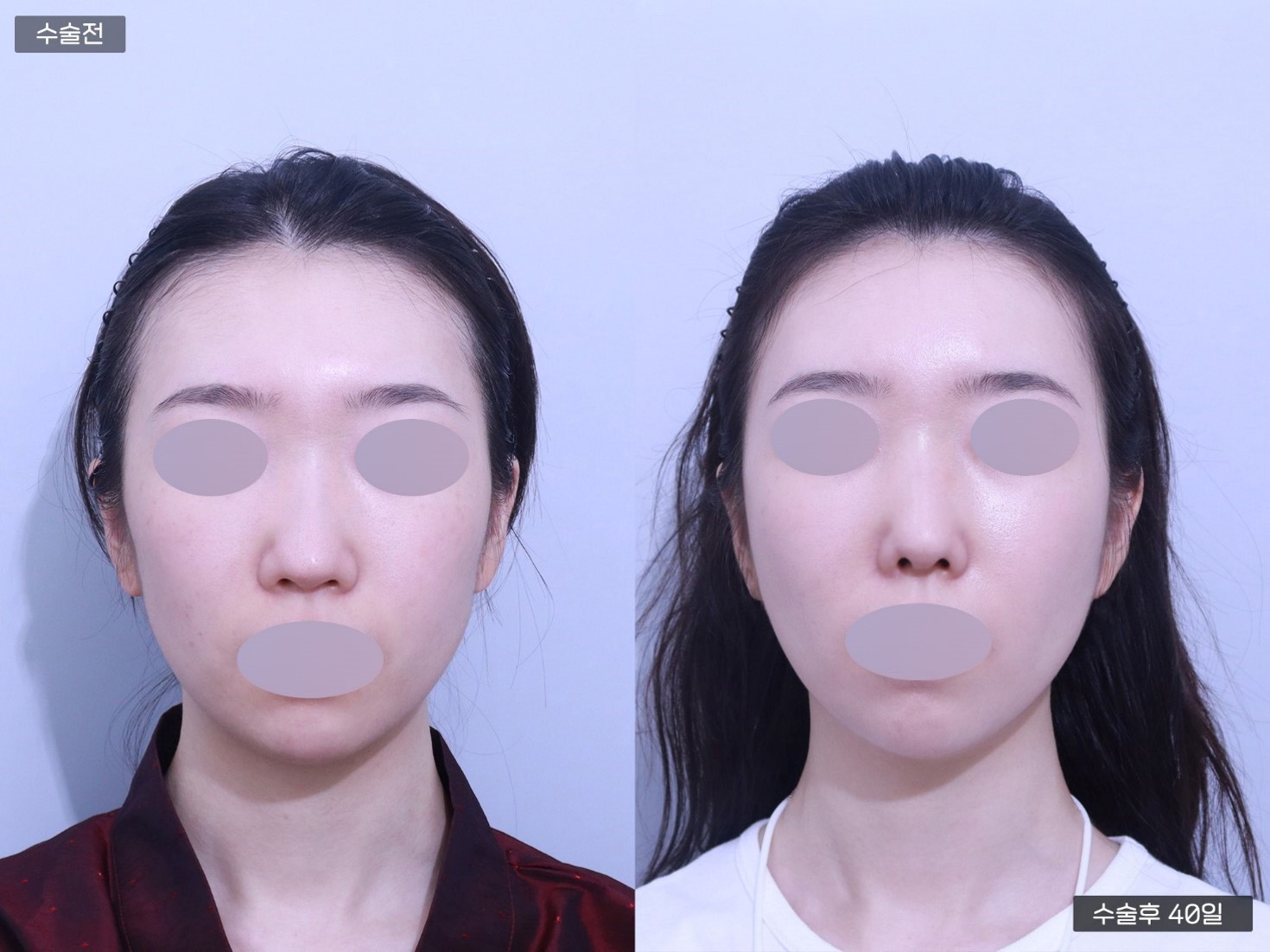 코재수술 + 복코교정 + PRP 풀페이스 지방이식