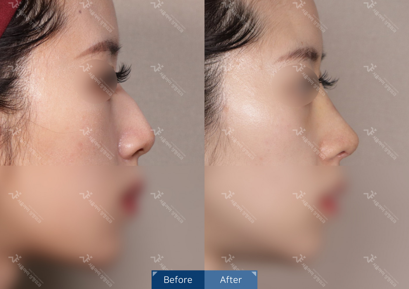 코성형 [코끝조각술+비중격+메부리코+휜코교정술]