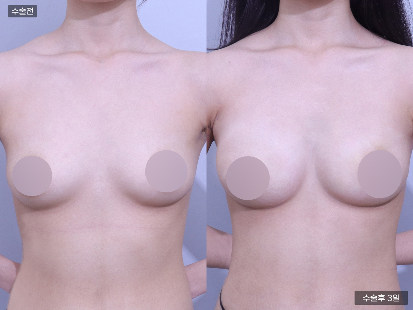 가슴성형 [가슴지방이식(250CC + 250CC)]