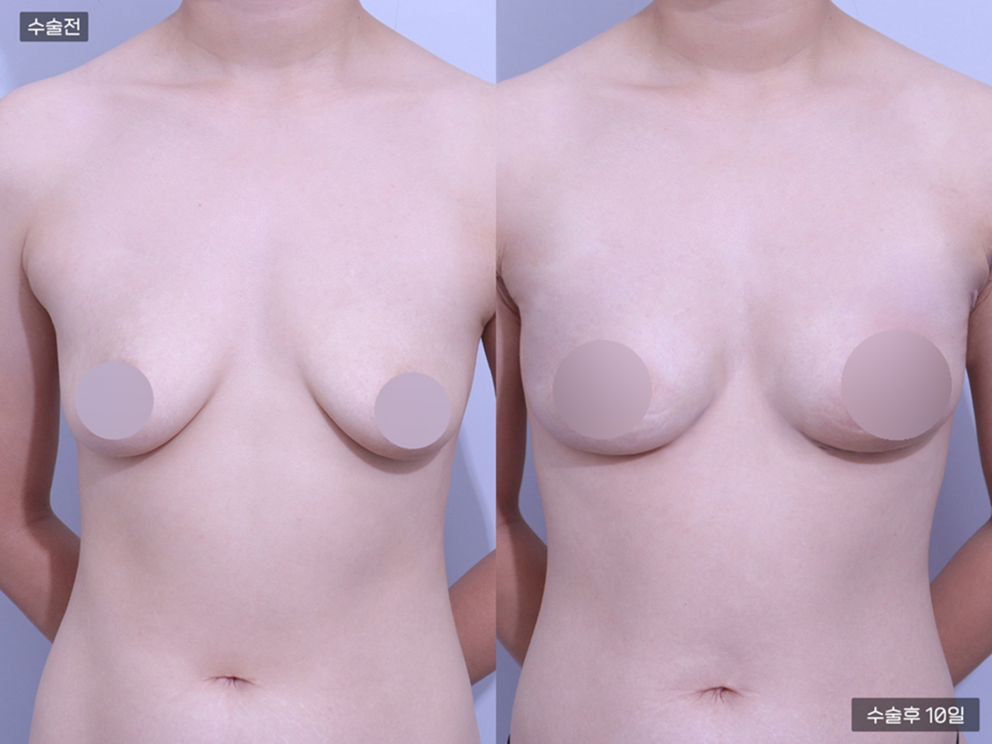 가슴성형 [가슴지방이식(250CC + 250CC)]