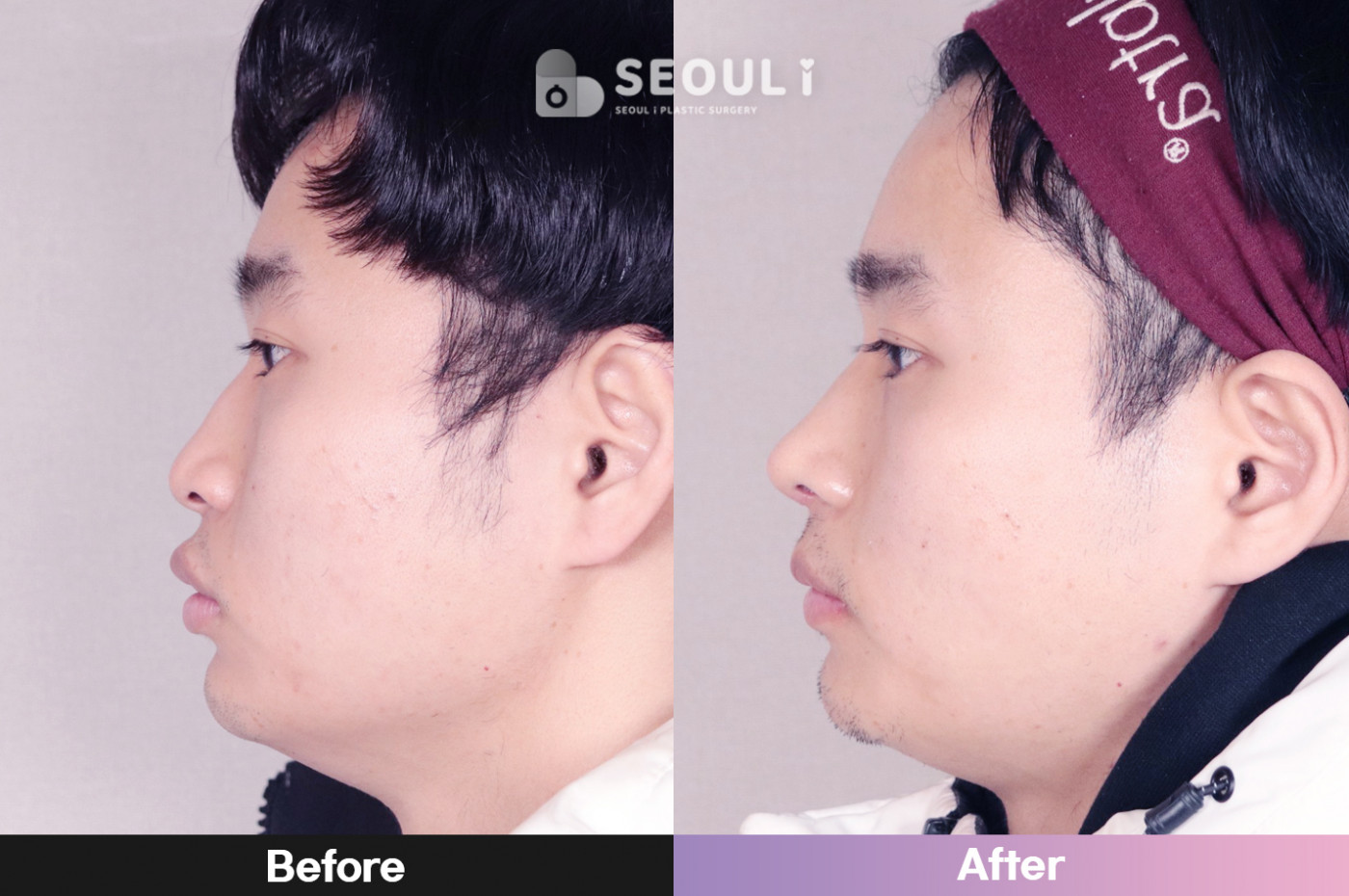 콧볼 축소술 + 매부리 교정