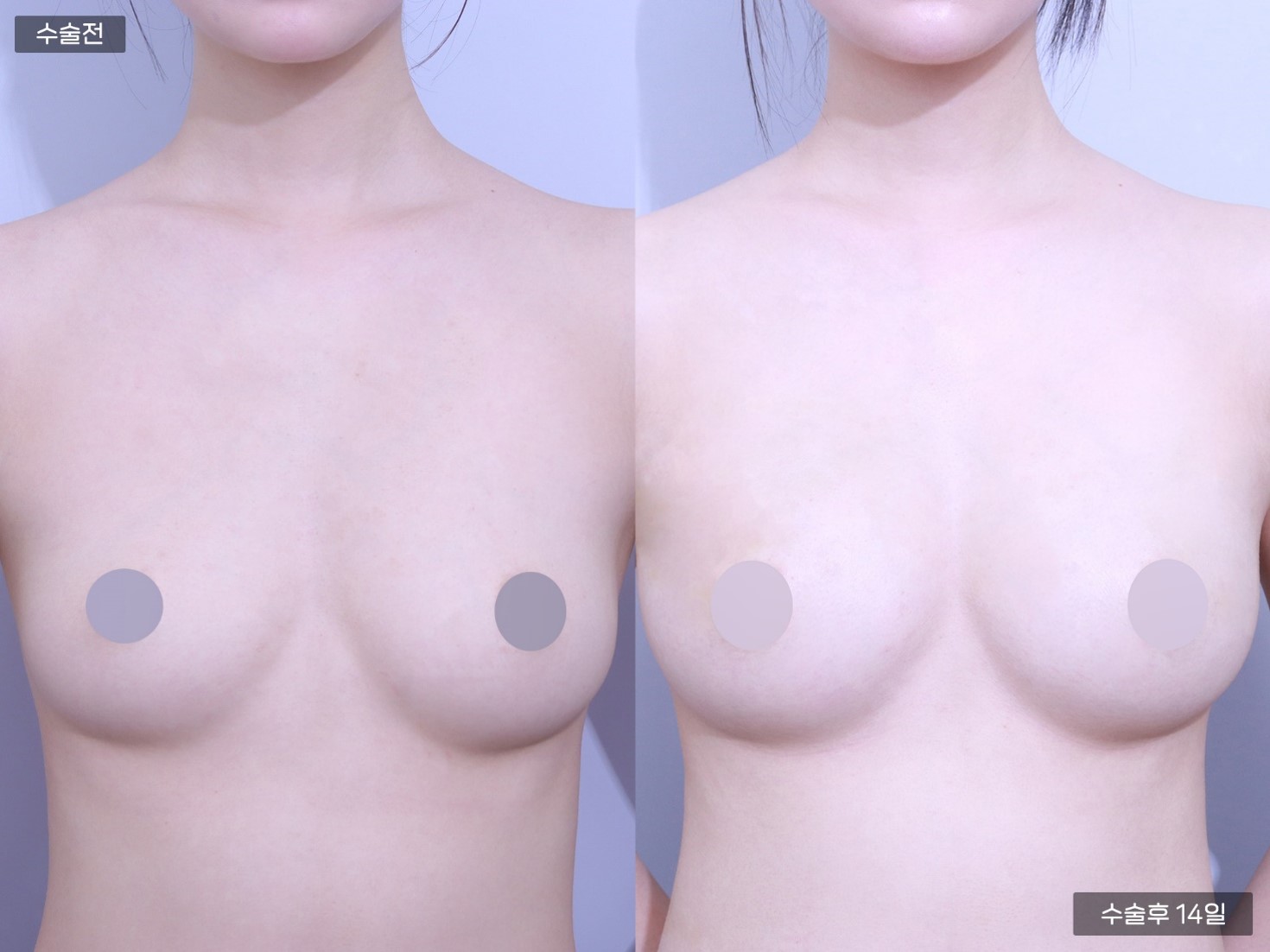 PRP 가슴지방이식 (300cc + 300cc)