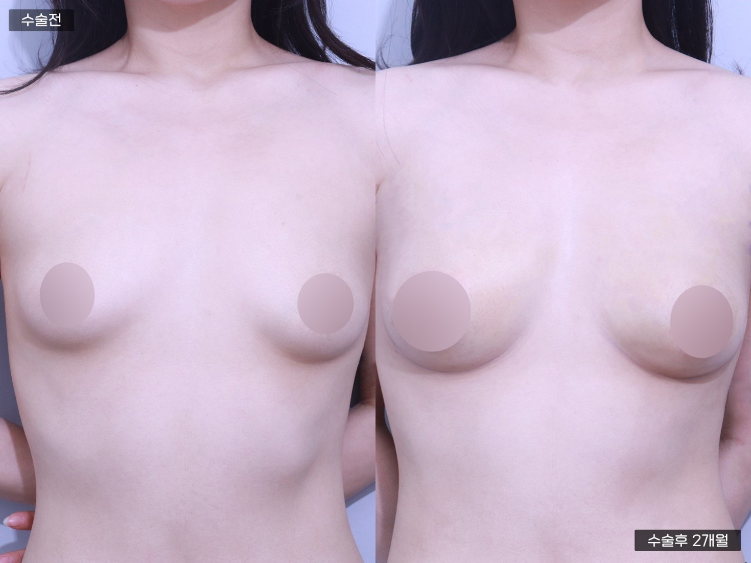 줄기세포 가슴지방이식 (250cc + 250cc)
