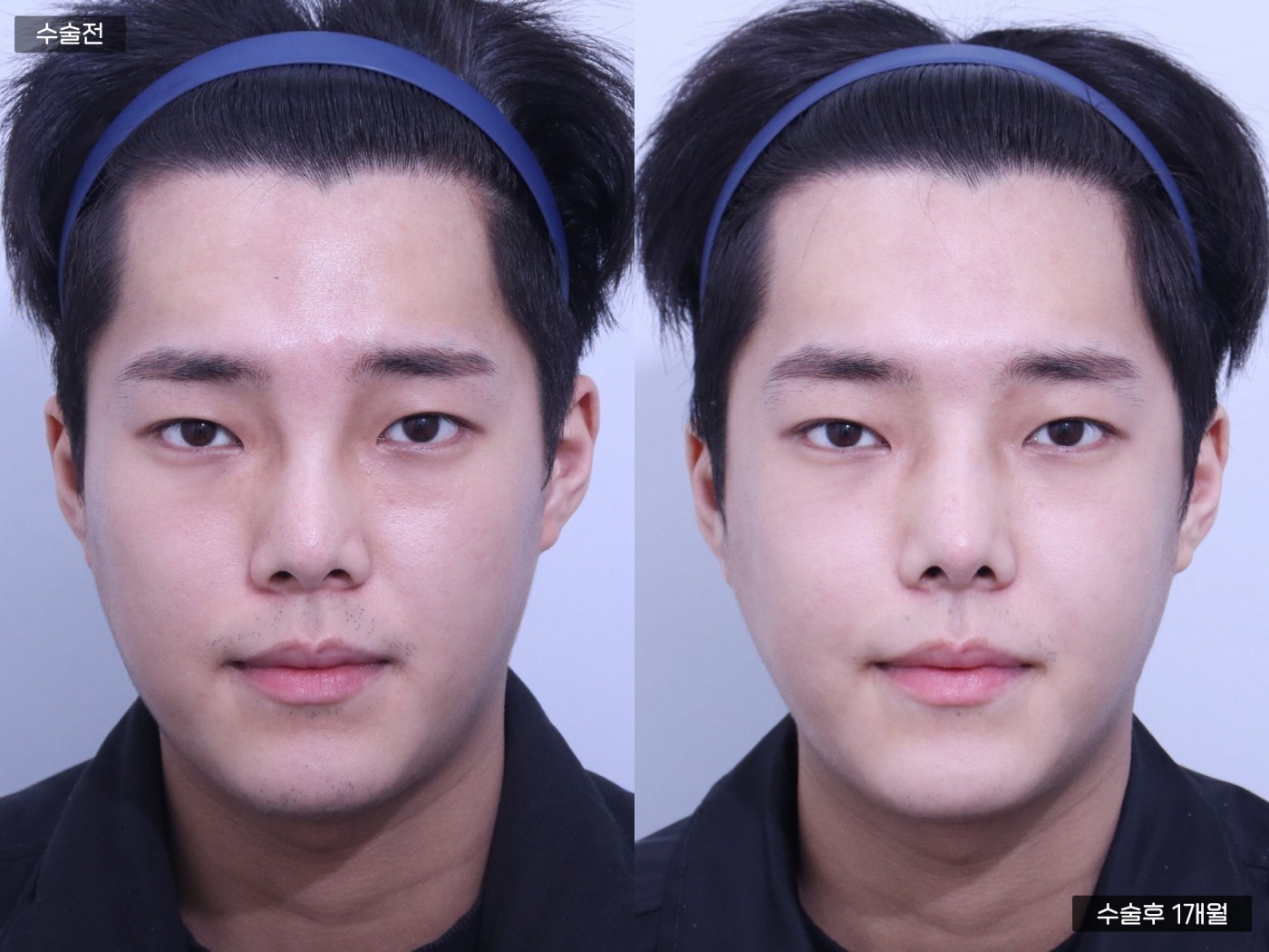 윤곽 1종 [광대] / 코성형 [복코 + 매부리]