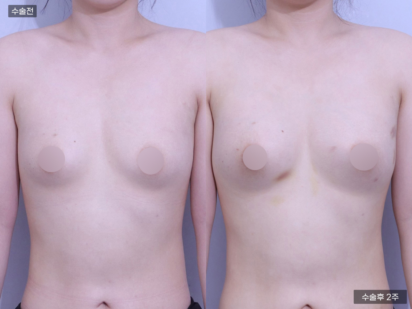 가슴성형 [가슴지방이식(300CC + 300CC)]