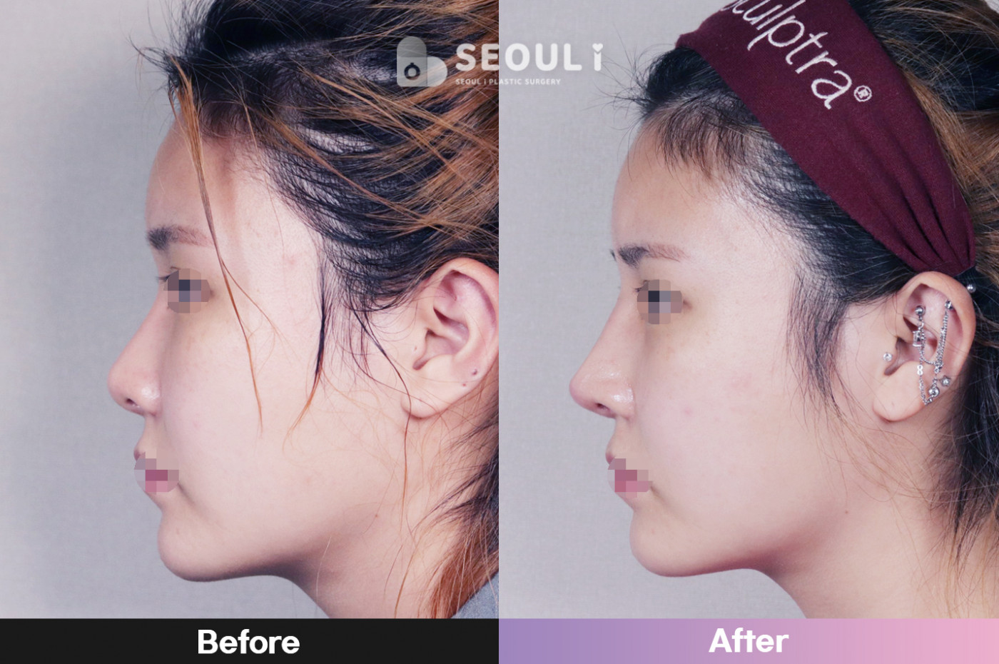 콧볼 축소술 + 매부리 교정