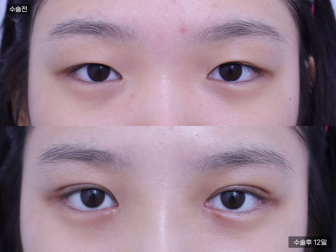 눈성형 [자연유착 쌍꺼풀 + 앞트임]