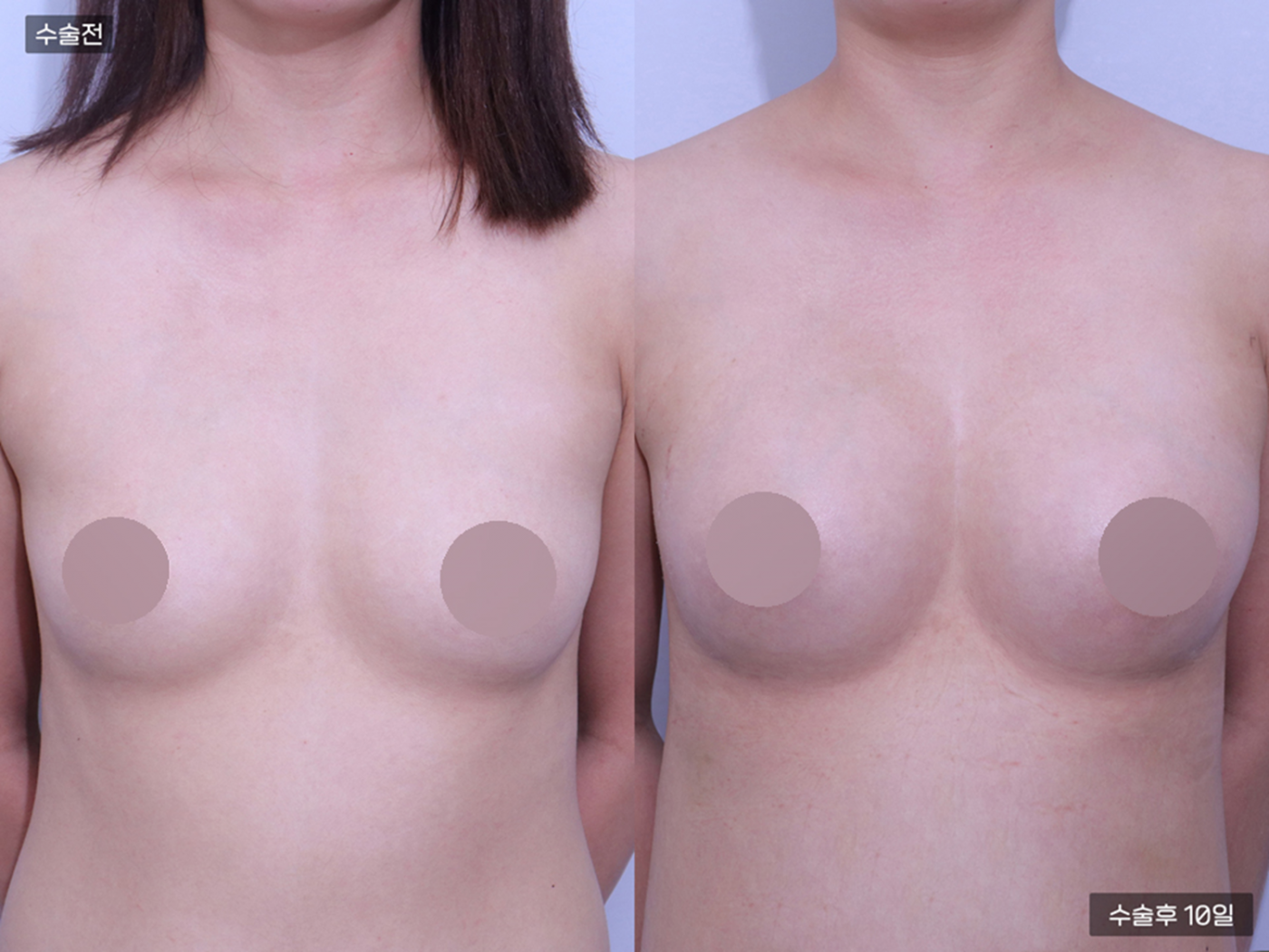 가슴성형 [가슴지방이식(250CC + 250CC)]