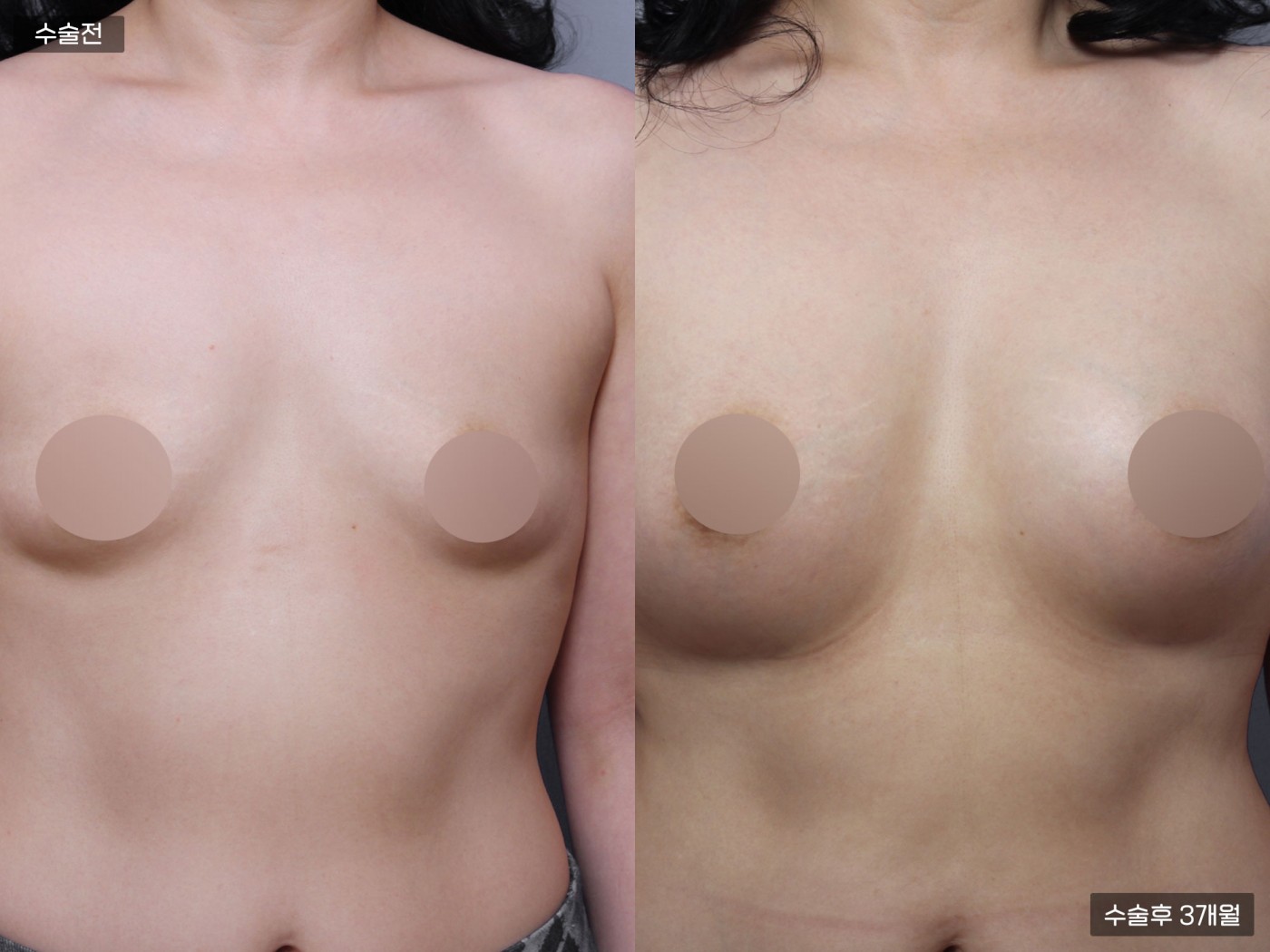 가슴성형 [내추럴가슴보형물 + 가슴지방이식]